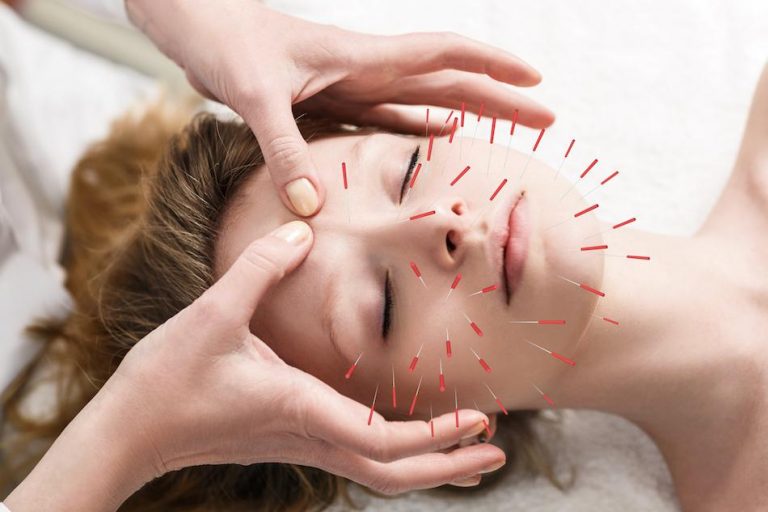Cosmetic Acupuncture – A Beautiful Thing